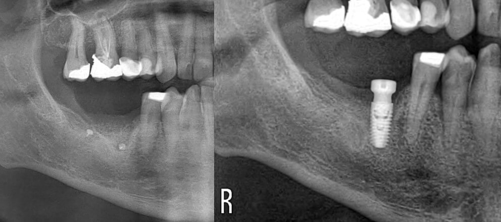 Ανάπλαση με αλλομόσχευμα μετά