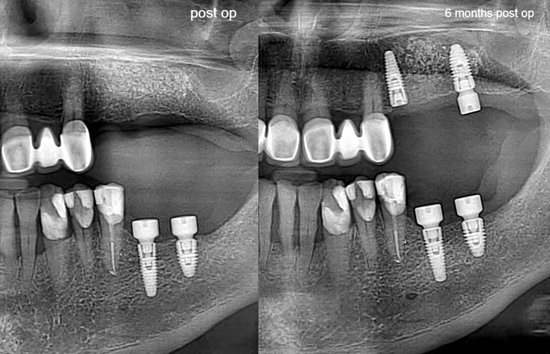 Ανύψωση ιγμορείου πριν