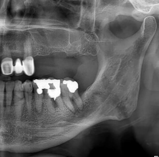 Ανύψωση ιγμορείου 