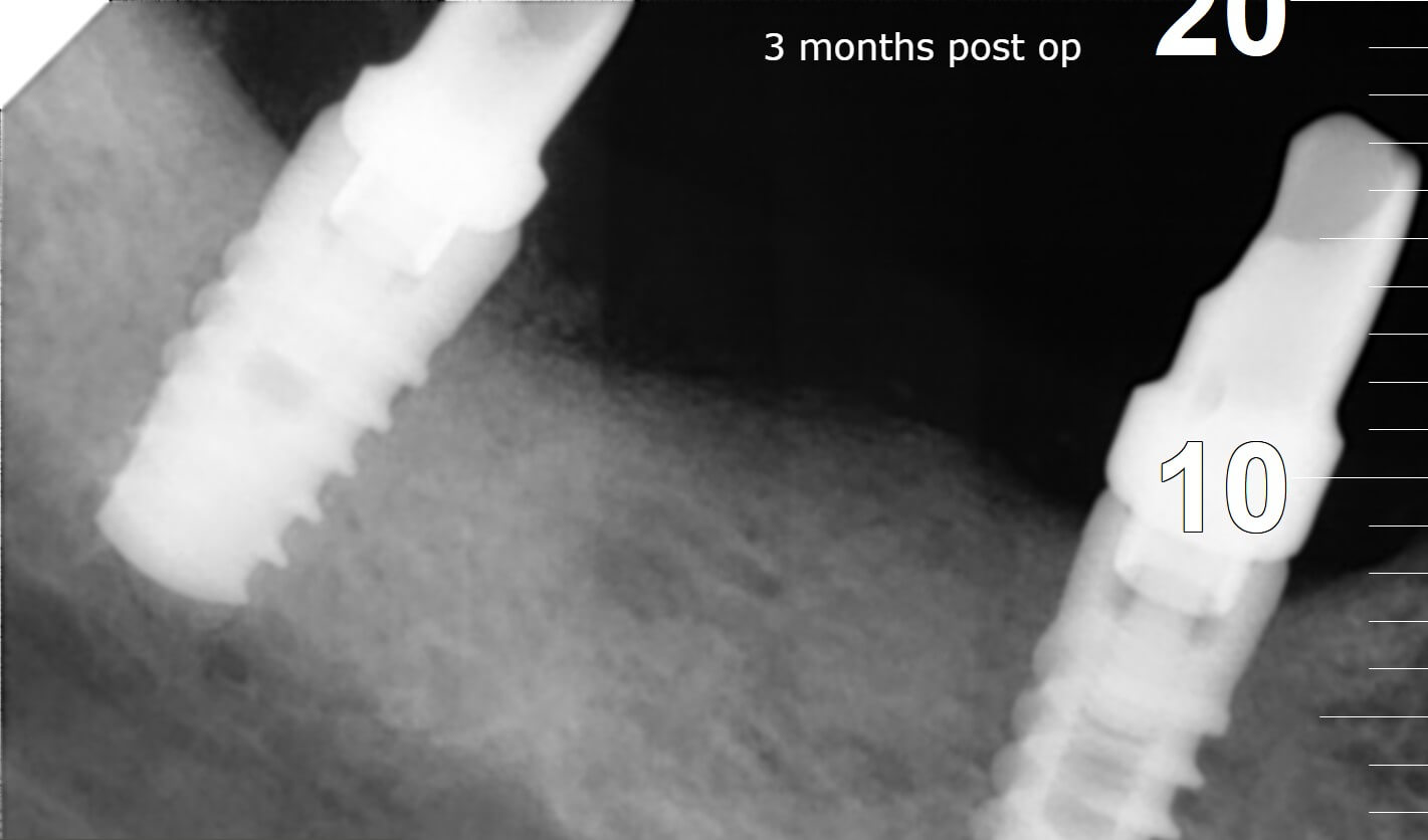 θεραπεία της περιεμφυτευματίτιδας μετα