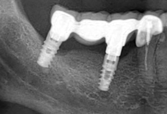 θεραπεία της περιεμφυτευματίτιδας