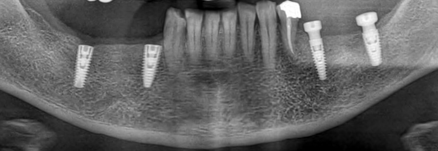 Οδοντικά εμφυτεύματα μετά