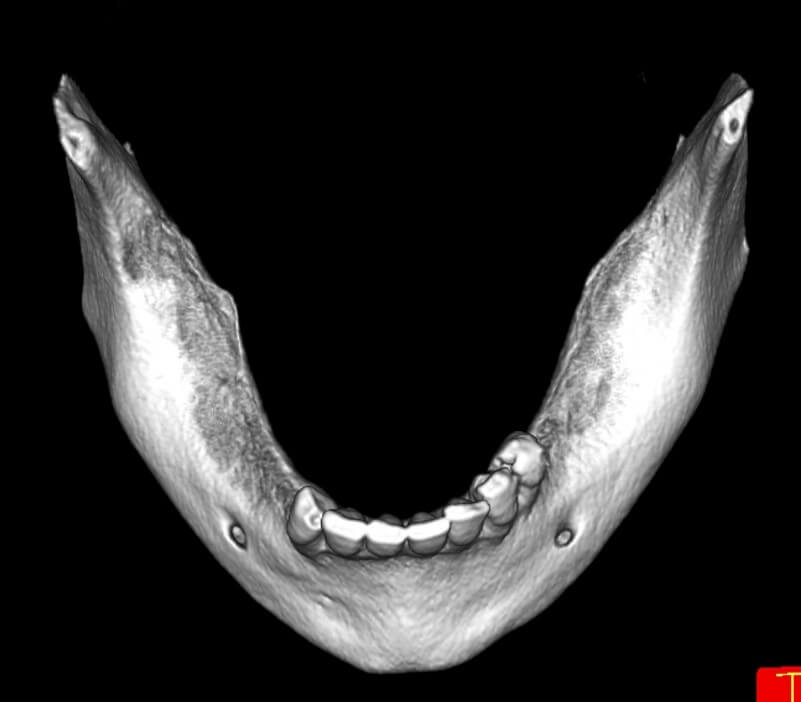 Οδοντικά εμφυτεύματα πριν