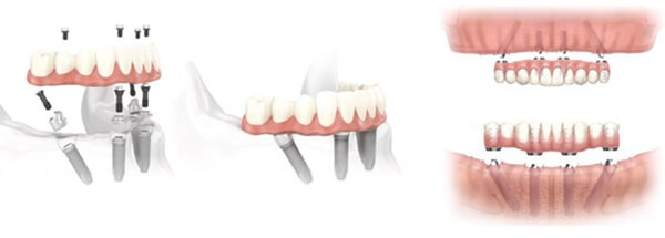 Μέθοδος All-on-4