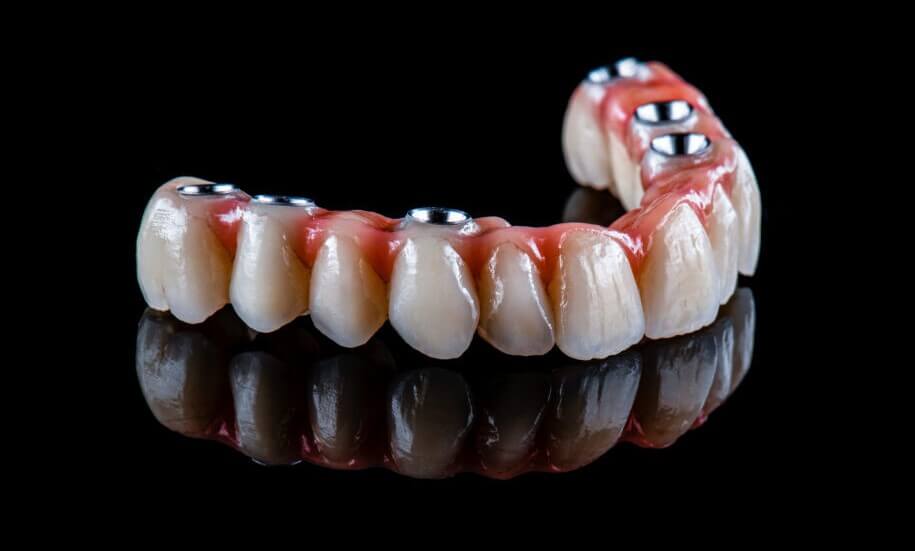 Μέθοδος All-on-4 - Οδοντοστοιχία από πορσελάνη